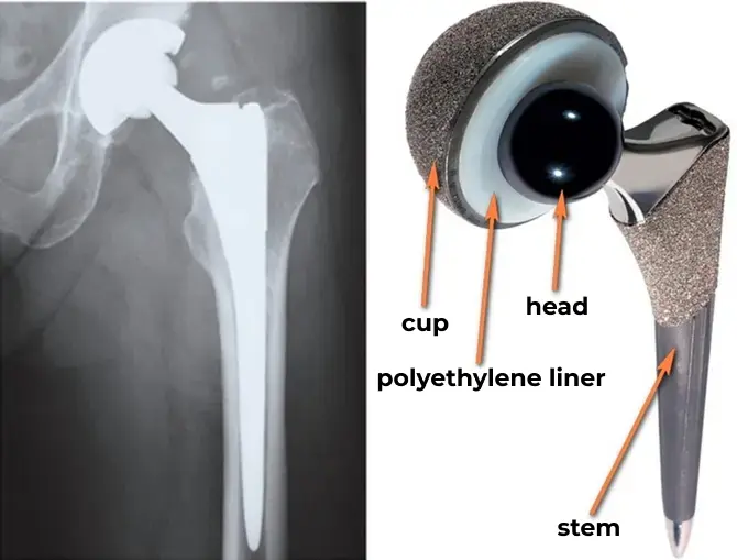 Components of a hip joint prosthesis